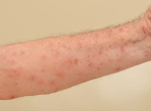 Loswerden krätze Krätze (Scabies)